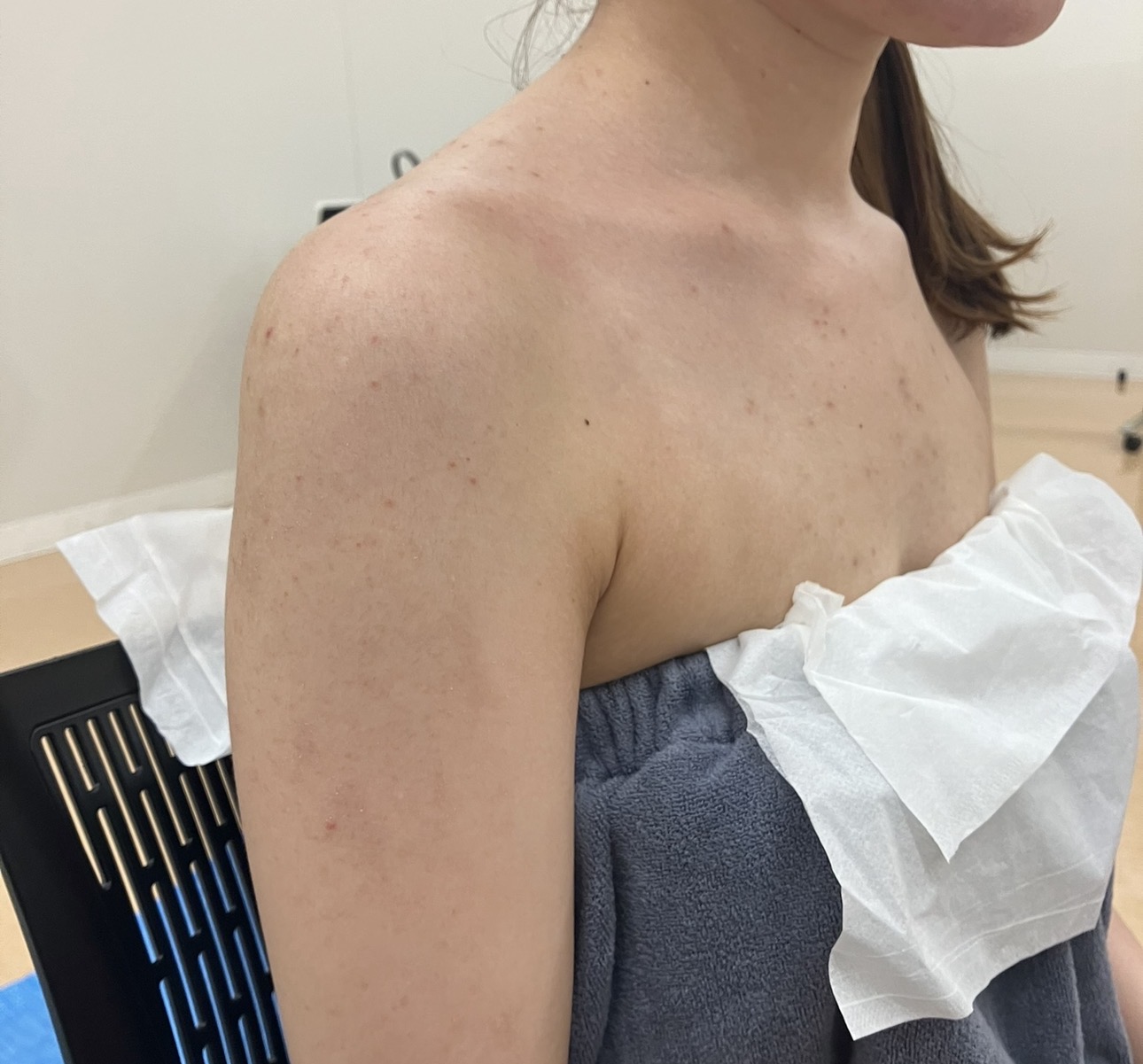 大分県 エアブラシメイクで肌のくすみをカバーした結婚式用ボディーカバーメイク