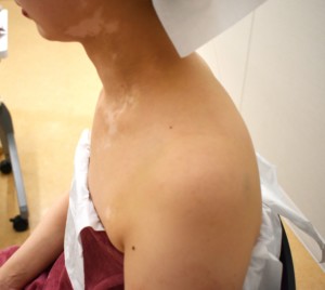 白斑カバーメイク #大分県結婚式#大分県#西大分結婚式#結婚式#ブライダル#ドレス姿#大分ウエディングドレス#ウエディングドレス#ボディーカバー#ブライダルボディーメイク#ブライダルトラブル#結婚式ドレス #別府#別府結婚式