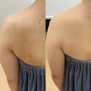 ニキビ跡や肌トラブルをエアブラシメイクでカバーしたベースメイクです。薄く重ねることで自然な仕上がりになります 大分県 結婚式