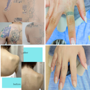 大分県結婚式 大分県で結婚式前に刺青をエアブラシでカバーした花嫁の背中メイク• 結婚式のドレス姿でも安心できる刺青カバーメイク(大分県エアブラシ) • 背中の刺青を広範囲にカバーしたブライダル用エアブラシメイク • 結婚式でドレスを着るのが不安な花嫁のための刺青カバー(大分県) • タトゥーを自然に隠したブライダルエアブラシメイク施術例