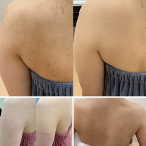 大分県結婚式 大分県でエアブラシメイクにより肌のくすみを自然にカバーしたブライダルメイク• 結婚式前の肌くすみを整えたエアブラシメイク施術例 • ドレス姿の花嫁の肌くすみを均一に整えたエアブラシカバーメイク • 大分県で肌トラブルやくすみをカバーしたブライダルメイク