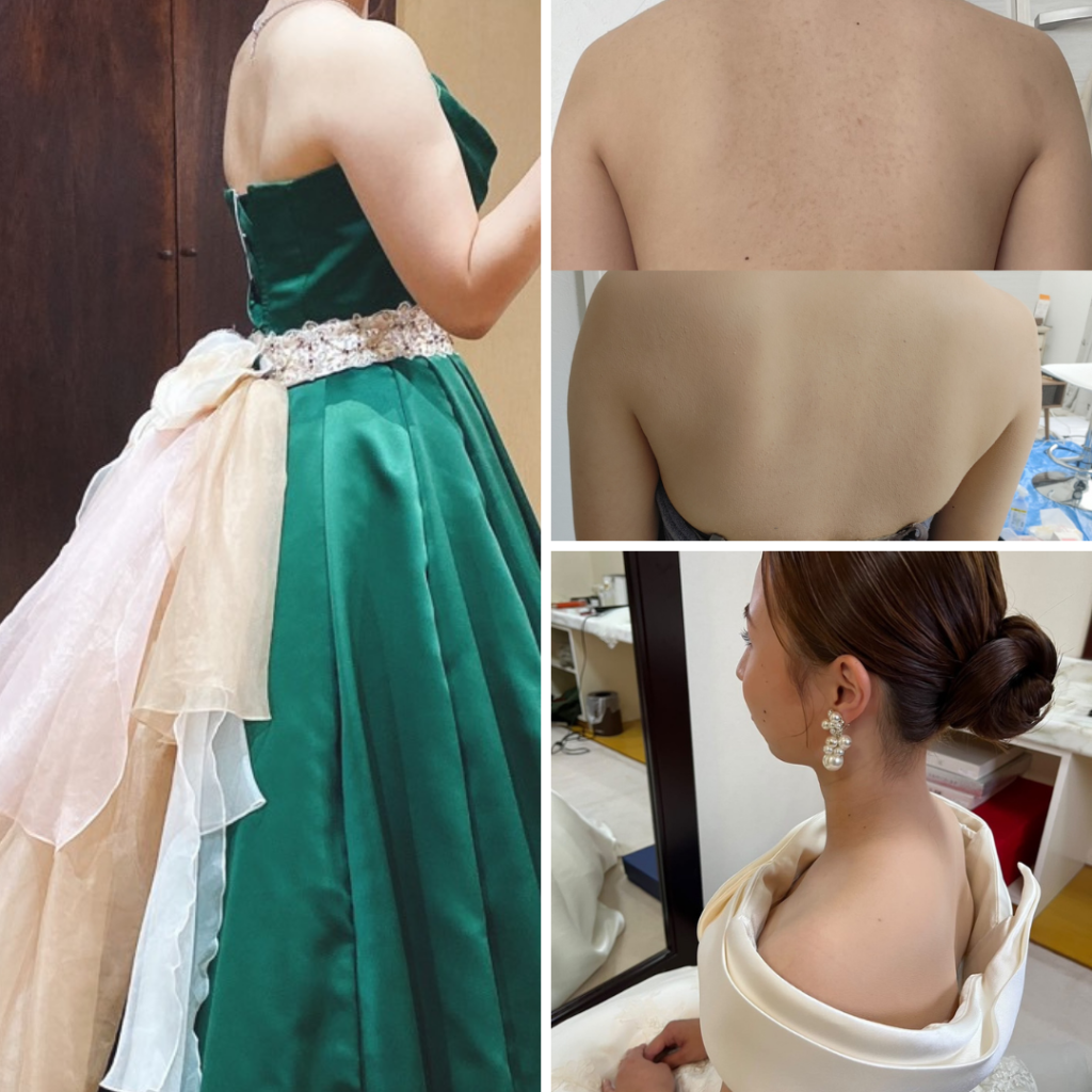 大分県結婚式カバーメイク 大分県結婚式大分県 エアブラシメイクでニキビ跡や肌荒れをカバーした結婚式メイク