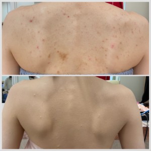 ボディーカバーメイク大分 結婚式当日に行うエアブラシカバーメイクのビフォーアフター。ドレス姿でも自然な仕上がりになります。 大分県結婚式