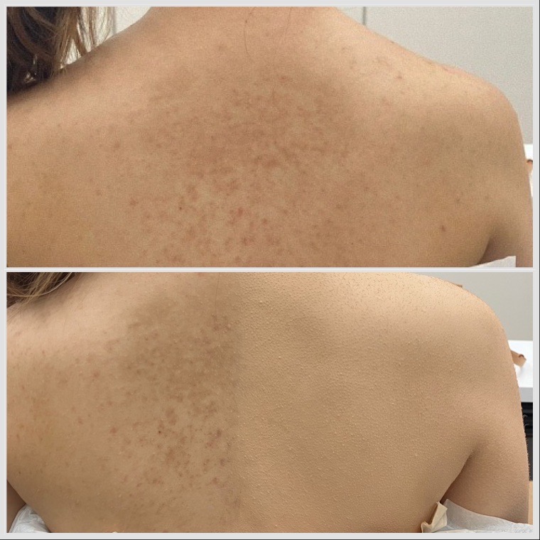 #大分県結婚式#大分県#西大分結婚式#結婚式場#ブライダル#ドレス姿#大分ウエディングドレス#ウエディングドレス#ボディーカバー#ブライダルボディーメイク#ブライダルトラブル#結婚式ドレス #別府#別府結婚式 大分県エアブラシ