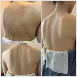 •	「ドレスを着たときに刺青が見えないか不安」という方へ。エアブラシメイクなら広範囲でも短時間でカバーできます