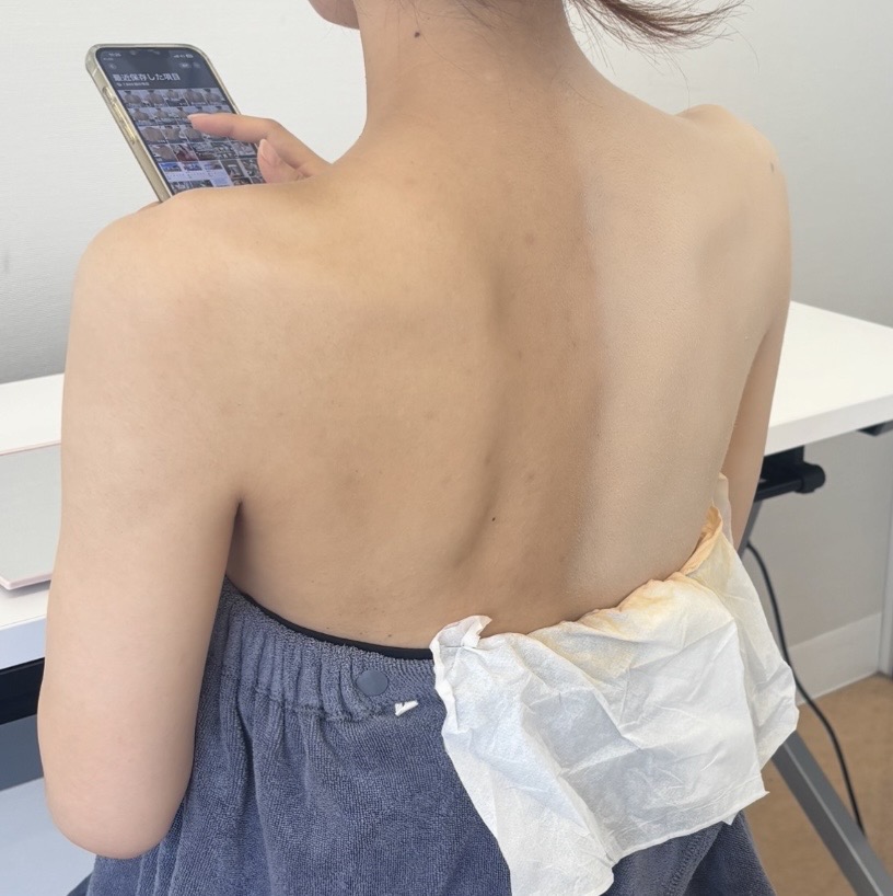 大分県 エアブラシメイクによるニキビ跡カバーのリハーサル 部分的にベースメイクを確認